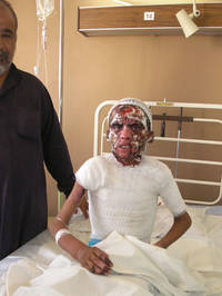 Ahmed bruciato dalla guerra