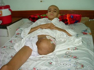 Bambino di 14 anni affetto da Sarcoma Osteogenico che ha portato l'amputazione della gamba, senza però riuscire a fermare la diffusione del cancro