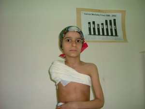 Bambina di 9 anni, affetta da Sarcoma Osteogenico. Braccio amputato per dolore troppo forte e mancanza di farmaci antidolorifici. Dolore fantasma tuttora presente